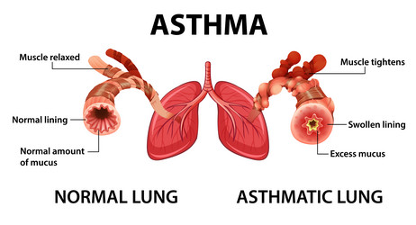 Asthma diagram with normal lung and asthmatic vector