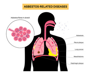 Asbestos related diseases vector