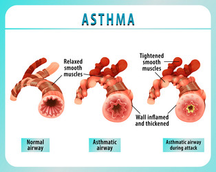 Bronchial asthma diagram with normal airway vector