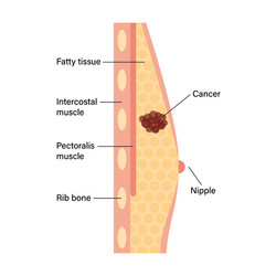 Breast disease concept vector