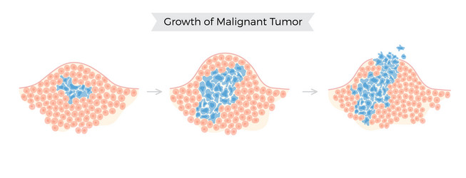 isolated malignant tumor vector