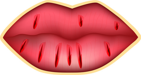 cracks in the lips dry chapped infographics vector