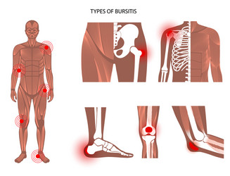 Bursitis icons set vector