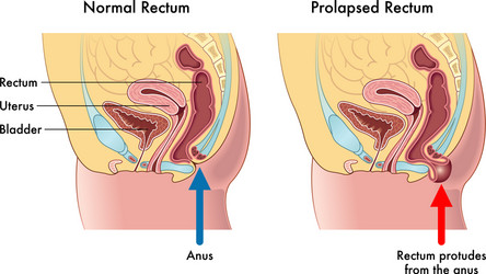 Rectal Vector Images (over 460)