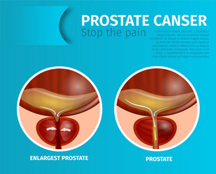 medical banner with normal and enlargest prostate vector