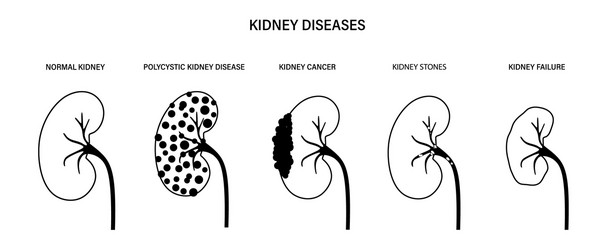Kidney disease concept Royalty Free Vector Image