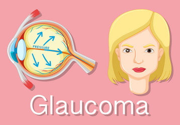 diagram showing eyes with glaucoma vector image