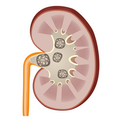 Kidney stones vector