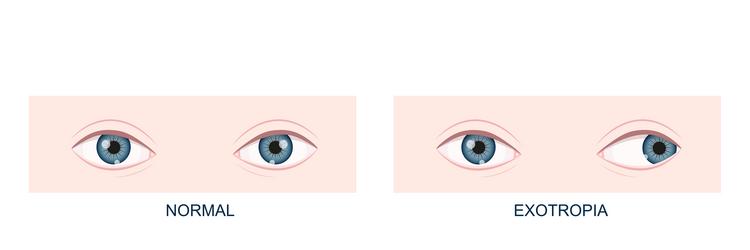 exotropia horizontal strabismus before and after vector