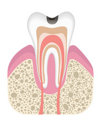 Stage of caries development tooth structure vector