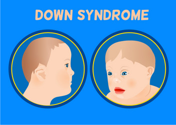 Down syndrom symptoms Royalty Free Vector Image