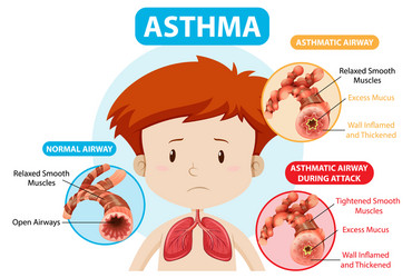 Asthma Diagram Vector Images (over 350)