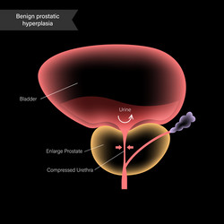 Bph info concept vector