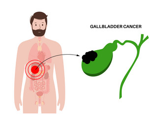 Gallbladder cancer anatomy vector