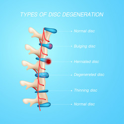 Disc Degeneration Vector Images (71)