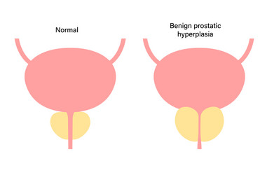 Bph info concept vector