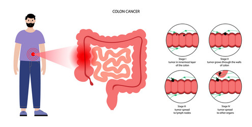 Colon cancer stage vector