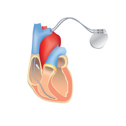 Heart Pacemaker Anatomy - ICD Device vector image