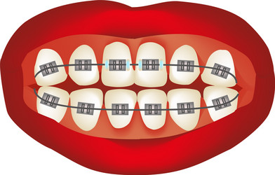 braces on the teeth infographics vector