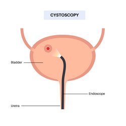 Cystoscopy examination concept vector