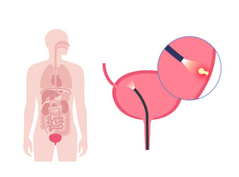 cystoscopy examination concept vector