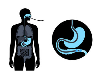 Double balloon enteroscopy Royalty Free Vector Image