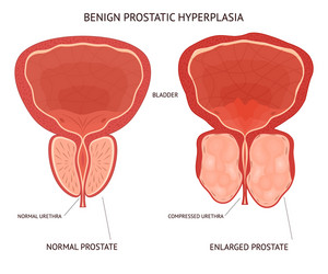 cartoon benign prostatic hyperplasia infographics vector