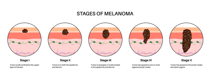 Melanoma stages poster vector