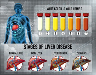 Stages liver disease Royalty Free Vector Image