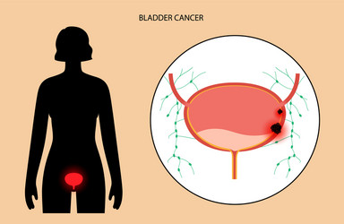 Bladder cancer stages vector