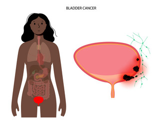 bladder cancer stages vector