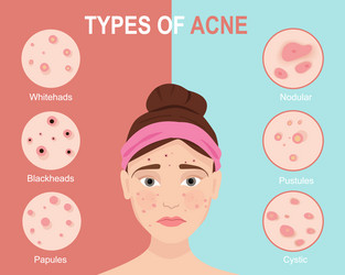 types of acne skin problems vector