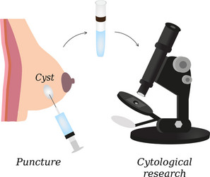 Puncture of cysts in the breast cytological vector