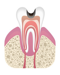 Stage of caries development tooth structure vector