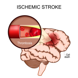 Brain stroke medical with human disease Royalty Free Vector