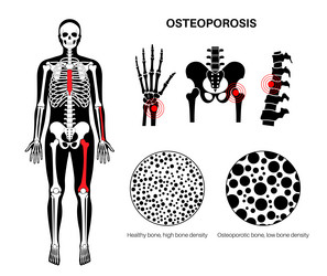 Osteoporosis medical poster vector