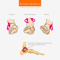 Ankle Sprain Vector Images (over 300)