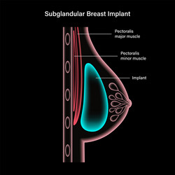 Breast implant concept vector