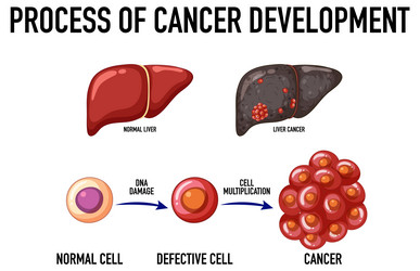 Process of cancer cell development Royalty Free Vector Image