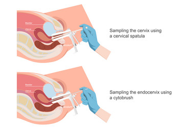 sampling the endocervix using endocervical vector image