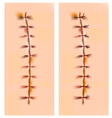 Scars with staples and sutures vector image